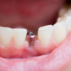 Имплантация зубов и хирургия